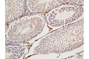 Formalin-fixed and paraffin embedded  labeled with Rabbit Anti-Cyclin H Polyclonal Antibody, Unconjugated (ABIN734408) at 1:200 followed by conjugation to the secondary antibody and DAB staining (Cyclin H 抗体  (AA 221-323))