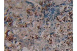 Detection of FMOD in Human Lung cancer Tissue using Polyclonal Antibody to Fibromodulin (FMOD)
