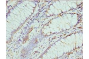 Immunohistochemistry of paraffin-embedded human colon cancer using ABIN7174682 at dilution of 1:100 (Cytidine Monophosphate (UMP-CMP) Kinase 1, Cytosolic (CMPK1) (AA 37-196) 抗体)