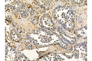 RNF87 Antibody at 1/100 staining human ovarian cancer by IHC-P.