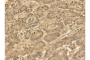 FOXO4 Mouse Monoclonal Antibody at 1/100 staining human colorectal cancer by IHC-P. (FOXO4 抗体  (Internal Region))