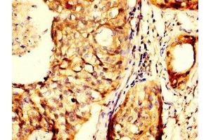 IHC image of ABIN7144013 diluted at 1:300 and staining in paraffin-embedded human cervical cancer performed on a Leica BondTM system. (RHCG 抗体  (AA 416-479))