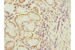 Immunohistochemistry of paraffin-embedded human gastric cancer using ABIN7172732 at dilution of 1:100 (MTERFD1 抗体  (AA 69-300))