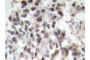Immunohistochemistry analyzes of PDCD4 antibody in paraffin-embedded human breast carcinoma tissue. (PDCD4 抗体)