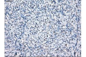 Immunohistochemical staining of paraffin-embedded Adenocarcinoma of breast tissue using anti-SLC7A8 mouse monoclonal antibody. (SLC7A8 抗体)