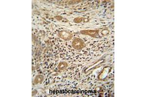 CTSA antibody (N-term) immunohistochemistry analysis in formalin fixed and paraffin embedded human hepatocarcinoma followed by peroxidase conjugation of the secondary antibody and DAB staining.