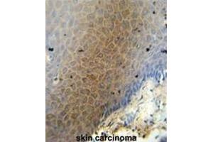 CEP70 antibody (Center) immunohistochemistry analysis in formalin fixed and paraffin embedded human skin carcinoma followed by peroxidase conjugation of the secondary antibody and DAB staining. (CEP70 抗体  (Middle Region))