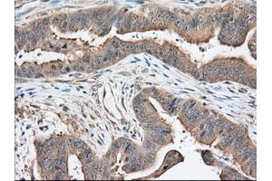 Immunohistochemical staining of paraffin-embedded Adenocarcinoma of Human colon tissue using anti-KHK mouse monoclonal antibody. (Ketohexokinase 抗体)
