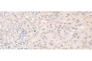 Immunohistochemistry of paraffin-embedded Human cervical cancer tissue using FOXRED2 Polyclonal Antibody at dilution of 1:35(x200) (FOXRED2 抗体)