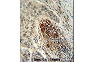 MFAP4 Antibody IHC analysis in formalin fixed and paraffin embedded human lung carcinoma followed by peroxidase conjugation of the secondary antibody and DAB staining. (MFAP4 抗体  (C-Term))