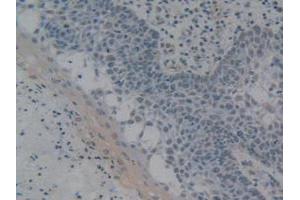 IHC-P analysis of Human Skin Cancer Tissue, with DAB staining. (HMGB1 抗体  (AA 9-163))