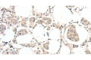 Immunohistochemistry of paraffin-embedded Human breast cancer tissue using TSPYL2 Polyclonal Antibody at dilution 1:30 (TSPY-Like 2 抗体)
