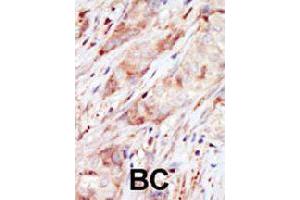 Formalin-fixed and paraffin-embedded human cancer tissue reacted with GCK polyclonal antibody  , which was peroxidase-conjugated to the secondary antibody, followed by AEC staining. (GCK 抗体  (C-Term))