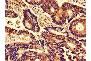 IHC image of ABIN7148865 diluted at 1:800 and staining in paraffin-embedded human colon cancer performed on a Leica BondTM system.