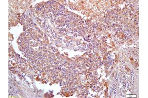Formalin-fixed and paraffin embedded human lung carcinoma labeled with Anti-PER2/Period circadian protein 2 Polyclonal Antibody, Unconjugated (ABIN872716) at 1:200 followed by conjugation to the secondary antibody and DAB staining (ANKRD1 抗体  (AA 185-319))