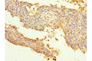 Immunohistochemistry of paraffin-embedded human cervical cancer using ABIN7174151 at dilution of 1:100 (SNRPB2 抗体  (AA 1-150))