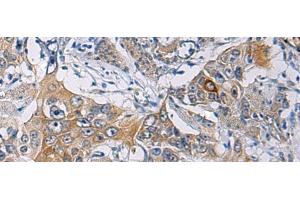 Immunohistochemistry of paraffin-embedded Human esophagus cancer tissue using KCNJ10 Polyclonal Antibody at dilution of 1:60(x200) (KCNJ10 抗体)