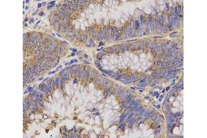 Immunohistochemistry of paraffin-embedded Human rectal cancer using TNFRSF1B Polyclonal Antibody at dilution of 1:200 (40x lens).