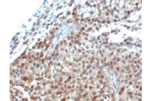 Formalin-fixed, paraffin-embedded human bladder carcinoma stained with p21 antibody (CIP1/823 + DCS-60.