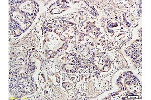 Formalin-fixed and paraffin-embedded human gastric carcinoma labeled with Rabbit Anti-IDE Polyclonal Antibody, Unconjugated (ABIN723680) at 1:300 followed by conjugation to the secondary antibody and DAB staining (IDE 抗体  (AA 491-590))