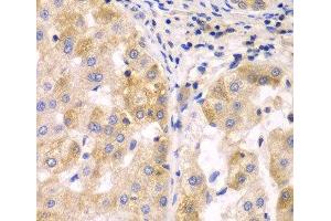 Immunohistochemistry of paraffin-embedded Human liver cancer using SULT2B1 Polyclonal Antibody at dilution of 1:100 (40x lens). (SULT2B1 抗体)
