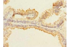 Immunohistochemistry of paraffin-embedded human prostate cancer using ABIN7160075 at dilution of 1:100 (MAP4K5 抗体  (AA 300-480))