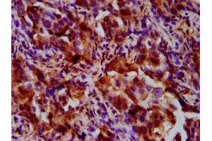 IHC image of ABIN7167644 diluted at 1:500 and staining in paraffin-embedded human lung cancer performed on a Leica BondTM system. (UPF3B 抗体  (AA 319-423))