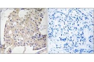 Immunohistochemistry analysis of paraffin-embedded human breast carcinoma tissue, using NDRG3 Antibody.
