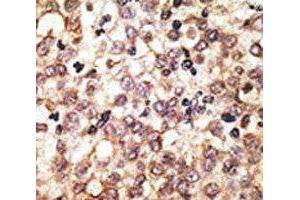 IHC analysis of FFPE human hepatocarcinoma tissue stained with the anti-TLR2 antibody (TLR2 抗体  (AA 720-749))