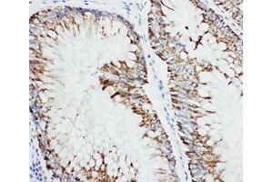 IHC-P: MAP3K1 antibody testing of human intestine cancer (MAP3K1 抗体  (C-Term))