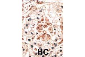 Formalin-fixed and paraffin-embedded human hepatocellular carcinoma tissue reacted with the HPCA polyclonal antibody  , which was peroxidase-conjugated to the secondary antibody, followed by DAB staining. (Hippocalcin 抗体  (N-Term))