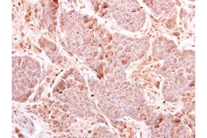 IHC-P Image MDA5 antibody [N2C1], Internal detects MDA5 protein at cytoplasm on human breast carcinoma by immunohistochemical analysis. (IFIH1 抗体)