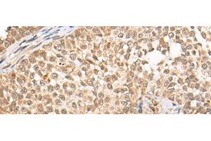 Immunohistochemistry of paraffin-embedded Human ovarian cancer tissue using CABIN1 Polyclonal Antibody at dilution of 1:50(x200) (CABIN1 抗体)