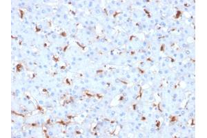 Formalin-fixed, paraffin-embedded human Hepatocellular Carcinoma stained with C1QB Mouse Monoclonal Antibody (C1QB/2961). (C1QB 抗体  (AA 41-188))