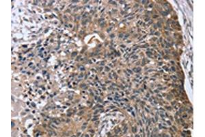 The image on the left is immunohistochemistry of paraffin-embedded Human esophagus cancer tissue using ABIN7130829(RASSF7 Antibody) at dilution 1/45, on the right is treated with fusion protein. (RASSF7 抗体)