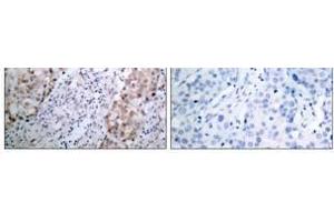Immunohistochemical analysis of paraffin- embedded human breast carcinoma tissue using HER2 (phospho-Tyr1221/Tyr1222) antibody (E011076). (ErbB2/Her2 抗体  (pTyr1221, pTyr1222))