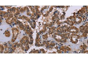 Immunohistochemistry of paraffin-embedded Human thyroid cancer tissue using GRK1 Polyclonal Antibody at dilution 1:40 (GRK1 抗体)