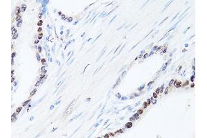 Immunohistochemistry of paraffin-embedded human colon carcinoma using SQSTM1 antibody (ABIN6290793) at dilution of 1:100 (40x lens).