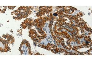 Immunohistochemistry of paraffin-embedded Human thyroid cancer using SERPINA9 Polyclonal Antibody at dilution of 1:60 (SERPINA9 抗体)