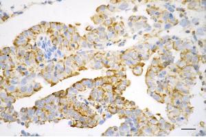 Immunohistochemistry was performed on paraffin-embedded human endometrial carcinoma using secreted phosphoprotein 1 antibody (ABIN7800287), 1:200).