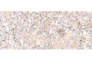 Immunohistochemistry of paraffin-embedded Human cervical cancer tissue using IL24 Polyclonal Antibody at dilution of 1:30(x200) (IL-24 抗体)