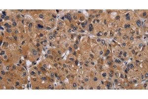 Immunohistochemistry of paraffin-embedded Human liver cancer using GNAS Polyclonal Antibody at dilution of 1:30 (GNAS 抗体)