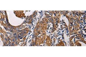 Immunohistochemistry of paraffin-embedded Human esophagus cancer tissue using SSH3 Polyclonal Antibody at dilution of 1:60(x200) (SSH3 抗体)