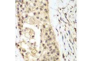 Immunohistochemistry of paraffin-embedded human lung cancer using FGFR1 antibody at dilution of 1:100 (400x lens). (FGFR1 抗体)