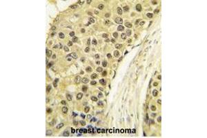 Formalin-fixed and paraffin-embedded human breast carcinoma tissue reacted with CCNA2 antibody (C-term) (ABIN391455 and ABIN2841432) , which was peroxidase-conjugated to the secondary antibody, followed by DAB staining. (Cyclin A 抗体  (C-Term))