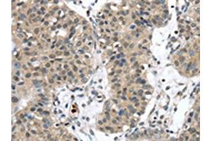 The image on the left is immunohistochemistry of paraffin-embedded Human breast cancer tissue using ABIN7192310(SENP6 Antibody) at dilution 1/20, on the right is treated with synthetic peptide. (SENP6 抗体)