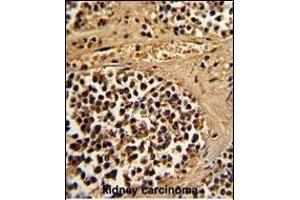 Formalin-fixed and paraffin-embedded human kidney carcinoma reacted with ESRRA Antibody (Center), which was peroxidase-conjugated to the secondary antibody, followed by DAB staining. (ESRRA 抗体  (AA 131-159))
