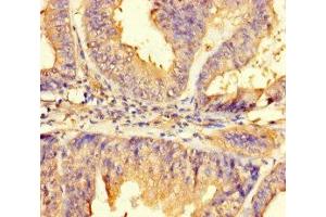 Immunohistochemistry of paraffin-embedded human endometrial cancer using ABIN7165645 at dilution of 1:100 (IMPACT 抗体  (AA 41-320))