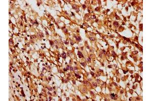 IHC image of ABIN7160617 diluted at 1:400 and staining in paraffin-embedded human melanoma performed on a Leica BondTM system. (MYO3B 抗体  (AA 1110-1276))