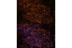 Immunofluorescence analysis of human kidney cancer using SCNN1G antibody (ABIN7270387) at dilution of 1:100. (SCNN1G 抗体  (AA 100-250))